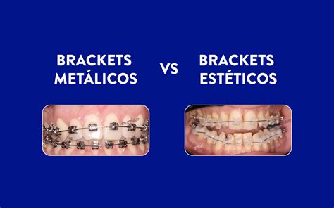 brackets esteticos vs metalicos|brackets metalicos.